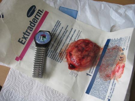 TUMEUR ENORME ENLEVEE A SUZY  !!!   .