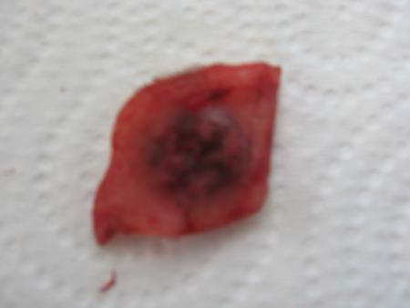 LE DESSOUS DE LA TUMEUR DE  LUCKY  .