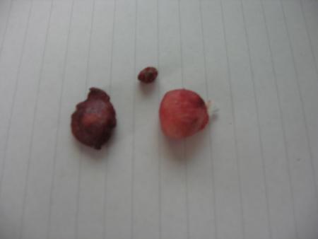 L OPERATION DE BEBE  .