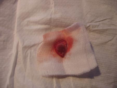 LE MELANOME ENLEVE  A   PACHA   .